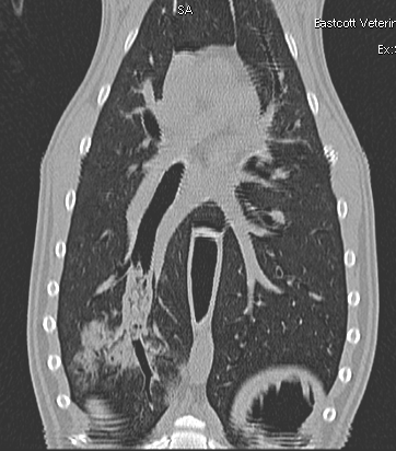 Bronchial foreign body